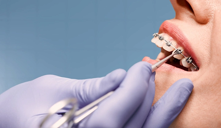 Cost of Braces in Singapore Explained: Options and Pricing Factors